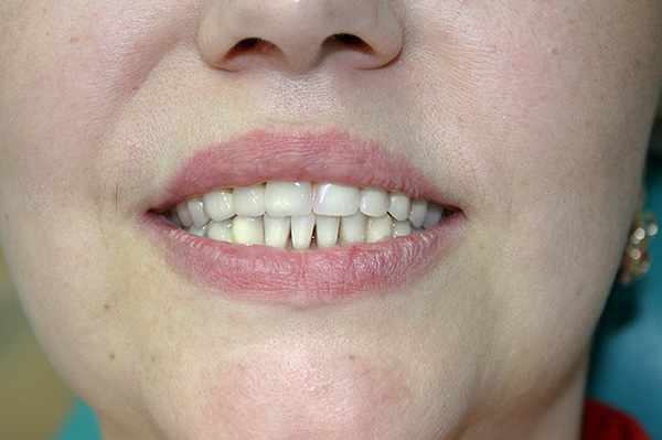 บางคนไม่ชอบฟันปลอมอะคริลิกในขณะที่ผู้ป่วยบางรายตอบสนองต่อพวกเขาอย่างดี