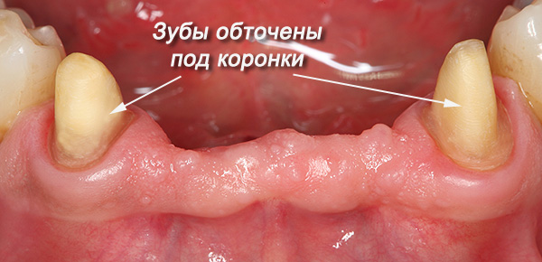 Teeth selected under the support for the prosthesis, usually grind under the crowns.