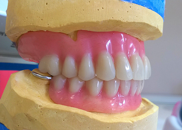 Así es como se ve la prótesis acrílica terminada en el modelo de yeso de la mandíbula.