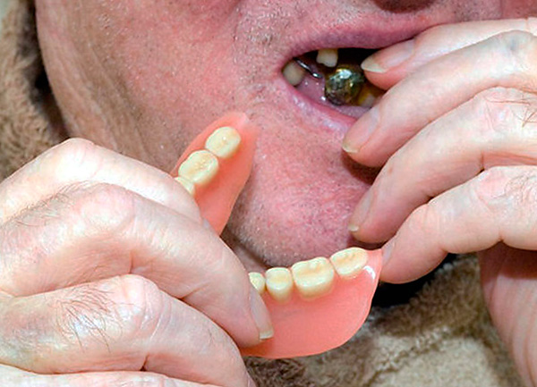 Ia adalah gigi palsu akrilik yang kadang-kadang dipanggil orang rahang palsu.