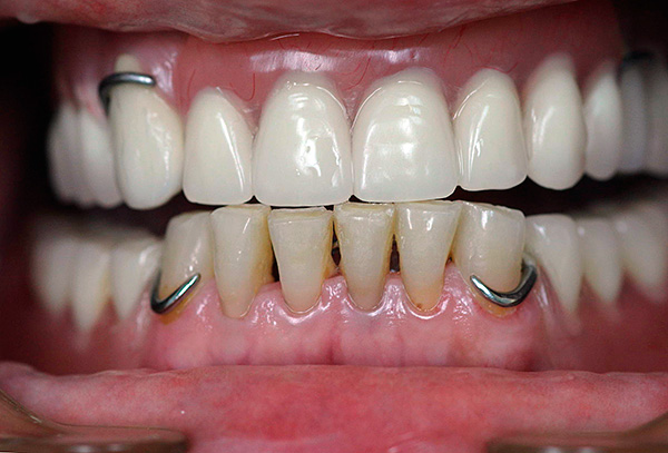 Els ganxos metàl·lics són els fermalls d’una dentadura acrílica.
