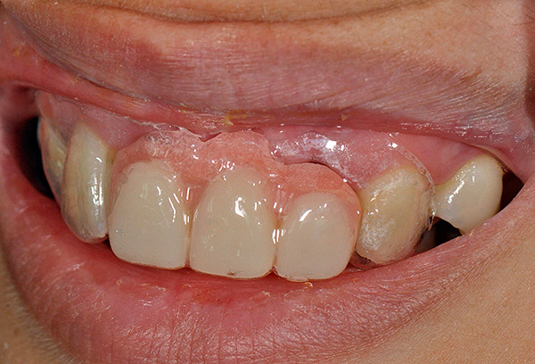 Εν τω μεταξύ, μια οδοντοστοιχία πεταλούδα μπορεί να μειώσει σημαντικά την ταλαιπωρία (συμπεριλαμβανομένης της ψυχολογικής) που συνδέεται με την απροσδόκητη απώλεια των δοντιών.