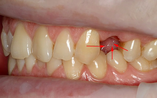 Nuotraukoje rodyklės rodo danties poslinkio kryptį, kai jų eilutėje atsiranda tuščia vieta.