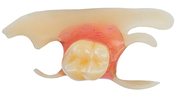 Као што пракса показује, чак и најједноставнија и најјефтинија протеза лептира може заштитити пацијента од врло непријатних проблема који се понекад појаве након вађења зуба.