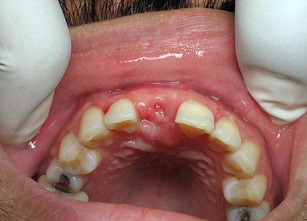 Es ist höchst unerwünscht, lange Zeit auf die Prothese extrahierter Zähne zu verzichten.