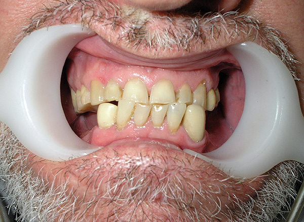 Cu cât protetica dinților lipsă este mai rapidă, cu atât este mai scăzut riscul consecințelor nedorite pentru întreaga dantură.