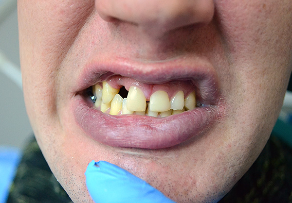 So sahen die Zähne des Patienten aus, bevor eine Schmetterlingsprothese verwendet wurde ...