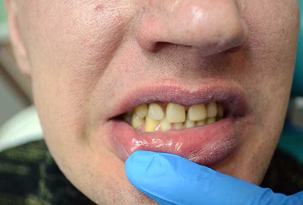 Kelebek protez, dişlerin estetiğini restore etti.