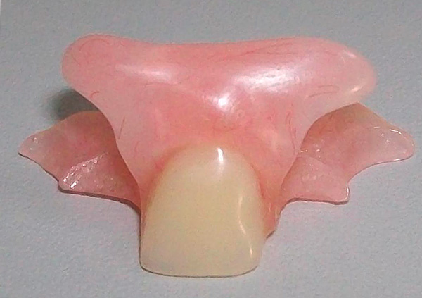 Butterfly prosthesis for prosthetics of the front tooth (incisor)