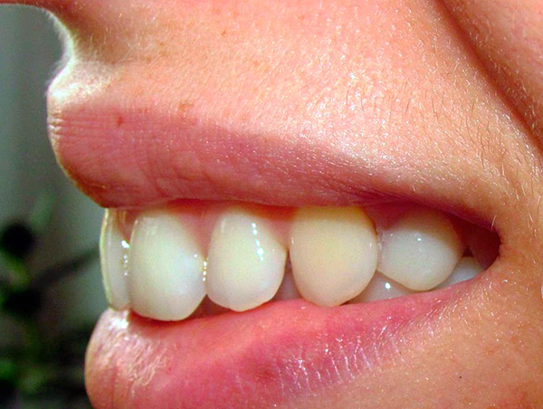 Und dieses Foto zeigt den Zustand der Zähne nach Verwendung der Schmetterlingsprothese.