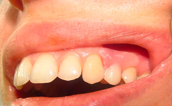 Proteesin palauttama hammas on käytännössä erotettavissa potilaan alkuperäishampaista.