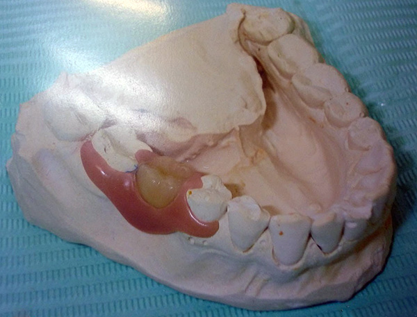 Τα βήματα για την κατασκευή οδοντοστοιχιών ακρυλικής και νάιλον πεταλούδας είναι γενικά τα ίδια.