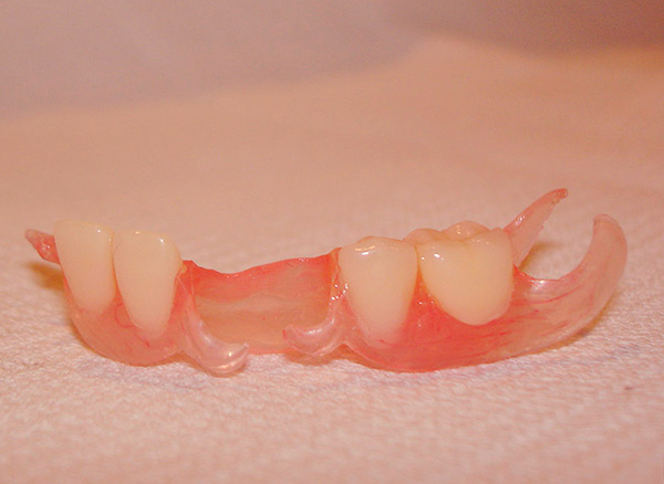 Przy dużej liczbie zębów protetycznych proteza implantu motyla nie jest już bardzo podobna ...