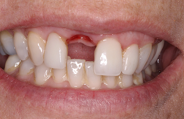 يكون فقدان الأسنان الأمامية مزعجًا بشكل خاص لمعظم الناس ، وسيكون الطرف الاصطناعي في هذه الحالة موضع ترحيب كبير.