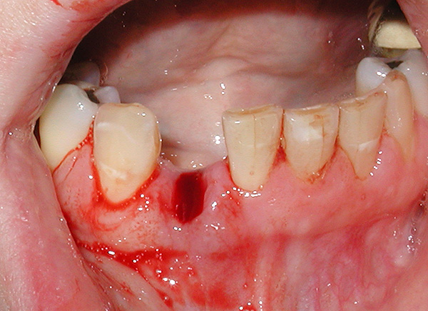 เมื่อใช้อวัยวะเทียมไม่จำเป็นต้องเดินเป็นเวลาหลายสัปดาห์โดยมีรูในฟัน