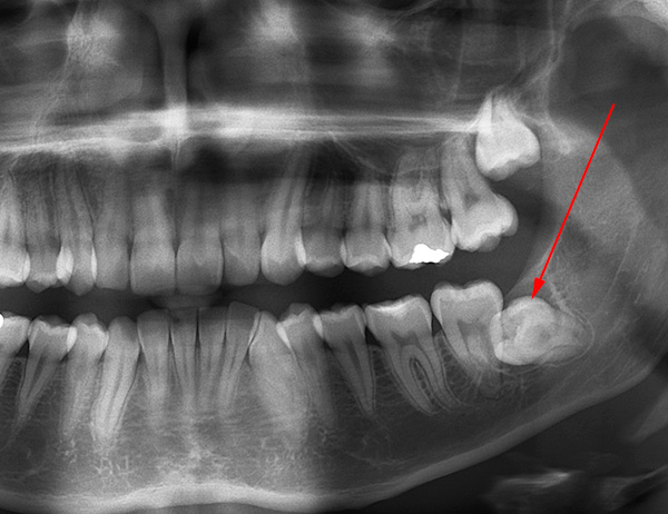 Låt oss prata om retinerade tänder (först av allt, visdom) och några nyanser i samband med deras borttagning ...