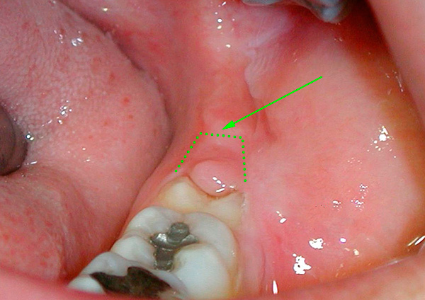Las muelas del juicio semi-reforzadas no siempre se extraen, a menudo se limitan solo a la escisión de la capucha gingival.