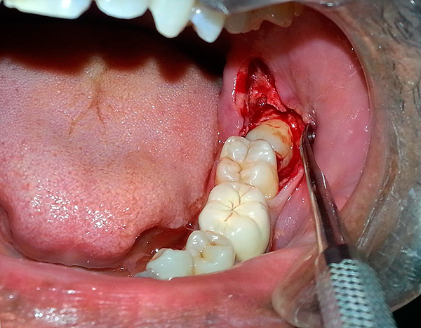 The photo shows the removal of the eighth lower tooth horizontally located in the jaw.