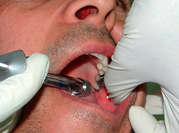 Dalam kebanyakan kes, anestesia tempatan membolehkan penghapusan gigi retina yang kompleks dengan hampir tiada kesakitan.