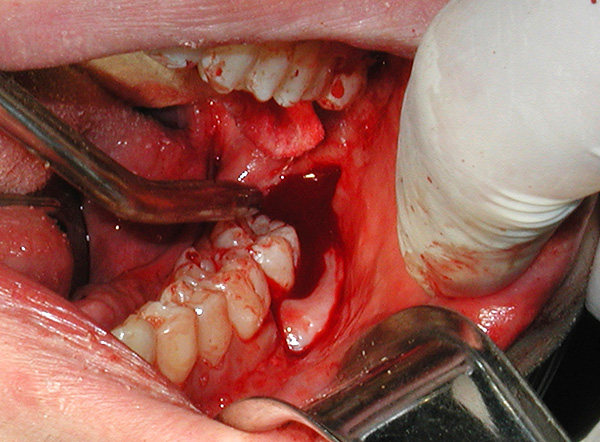 ตัวอย่างของการลบฟันปัญญาอ่อนที่ต่ำกว่า