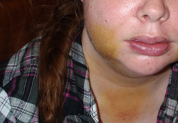 The photo shows an example of a bruise formed after the removal of the lower wisdom tooth.