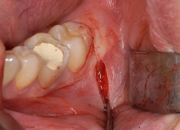 Pour retirer une dent de sagesse retardée de la mâchoire, une incision de gencive est d'abord effectuée.