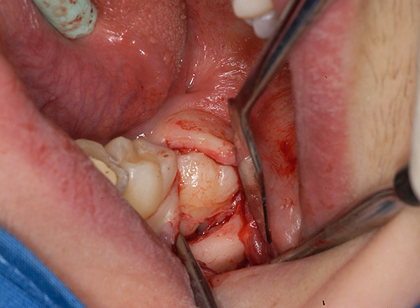 Der koronale Teil des retinierten Zahns ist im Lumen der Inzision sichtbar.