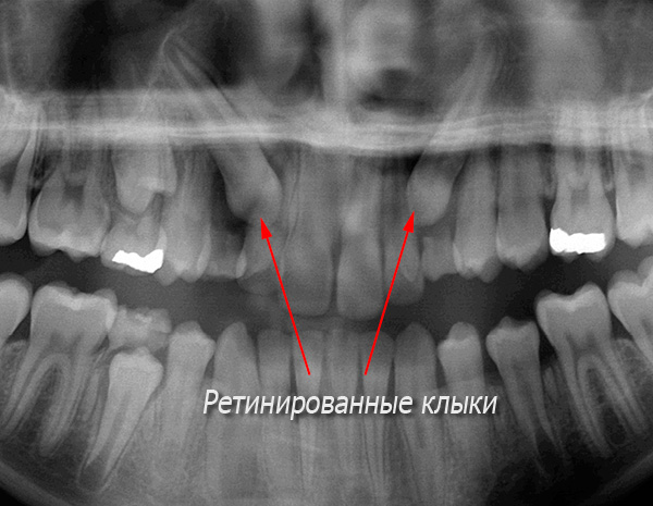 Na tym zdjęciu rentgenowskim kły siatkówki są wyraźnie widoczne.