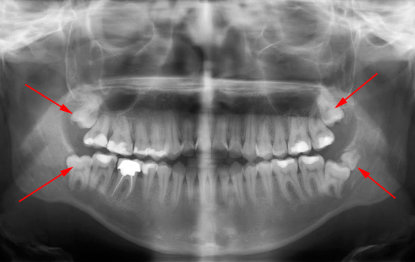 D'une manière générale, plusieurs théories expliquent pourquoi les dents de sagesse ne peuvent pas éclater normalement ...