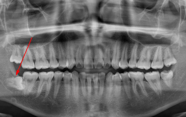 S vodorovnou polohou zubu moudrosti v čelisti se opírá o sedm, v důsledku čehož nemůže projít.