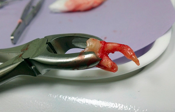 Retardovaný zub není vždy odstraněn, i když v některých případech je to skutečně nutné.