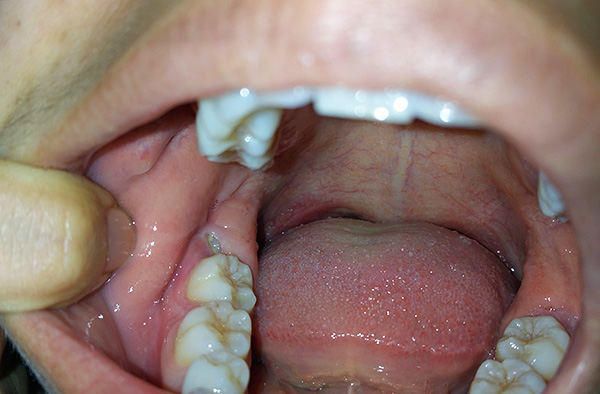 في كثير من الأحيان ، يتم قطع الثمار من دون ألم تمامًا ، وتأخذ مكانها في نهاية الأسنان.