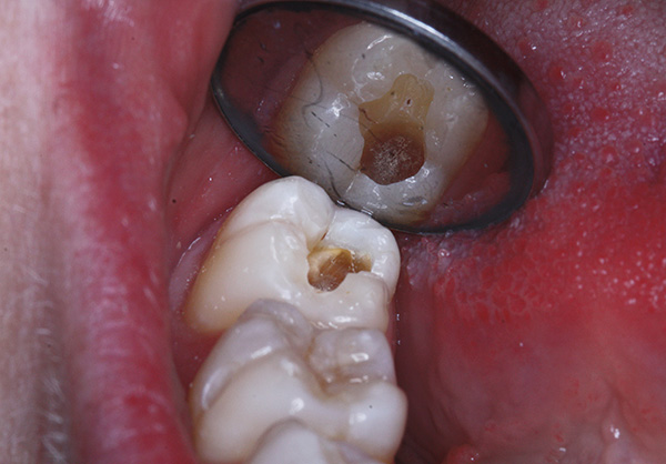 في بعض الأحيان يبدو للمرضى أن الطبيب يجتهد في حفر الأسنان بشكل مفرط ، كما لو كان يستمتع بهذه العملية ...