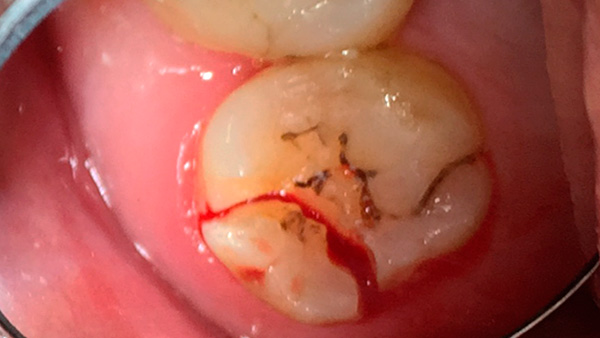 Pokud se zub (nějaký) rozpadne tak, že trhlina prochází hluboko pod dásní, pak jsou možnosti protetiky zpravidla velmi omezené.