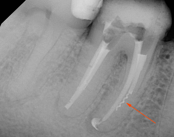 Kanavaan jäävä hammasinstrumentin fragmentti on selvästi näkyvissä kuvassa - jos sitä ei poisteta, se voi tulevaisuudessa aiheuttaa tulehdusta hampaan juuren kärjessä.