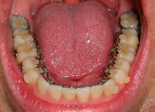 Diş telleri takarken, bilgelik dişlerini çıkarmak her zaman gerekli değildir.