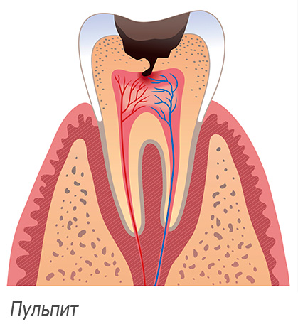 Pulpitída zuba je schematicky znázornená na obrázku.