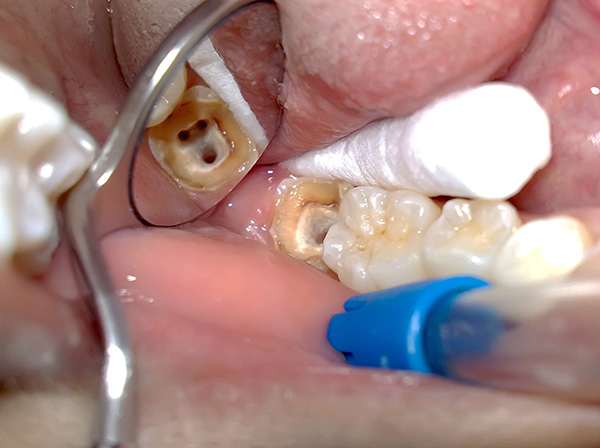 The more channels there are in the wisdom tooth, the more expensive it will be to treat with pulpitis.