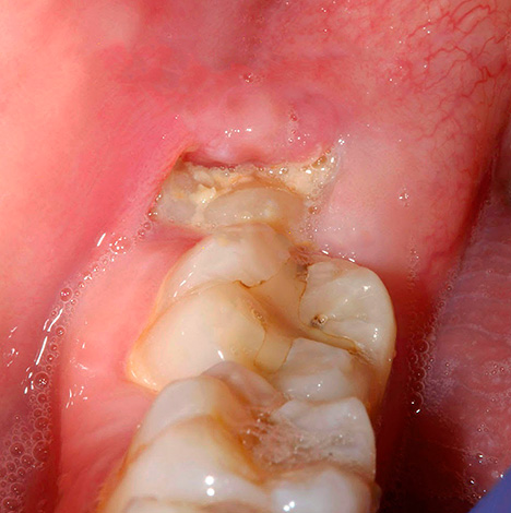 Muela del juicio semi-diente