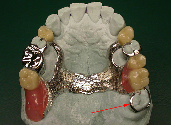 Gudrības zobus var izmantot kā zobu protēžu atbalstu.