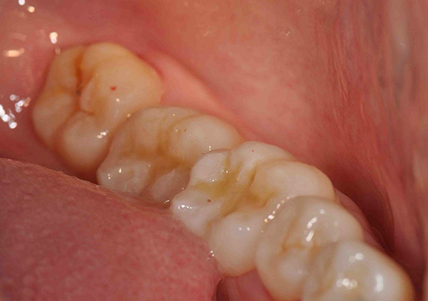 Σε πολλές περιπτώσεις, συνιστάται η θεραπεία της τερηδόνας σε ένα δόντι σοφίας αντί να σπεύδουν να αφαιρέσουν ένα τέτοιο δόντι.