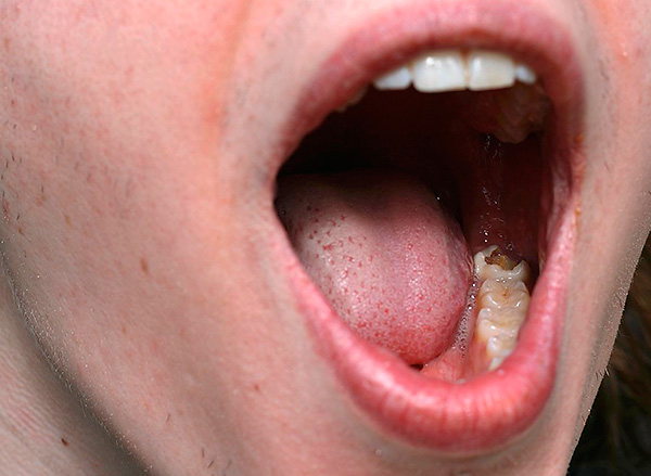 I při tak výrazném zubním kazu může být někdy odstraněn před odstraněním.