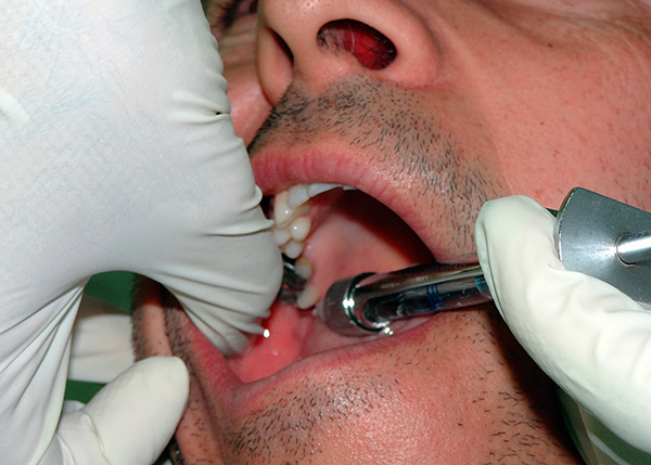 Účinné použití anestetika umožňuje léčit zuby moudrosti absolutně bezbolestně (ve většině případů).