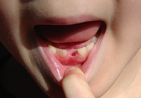 Μερικές φορές είναι απαραίτητο να αφαιρέσετε χειρουργικά τα δόντια του γάλακτος ...