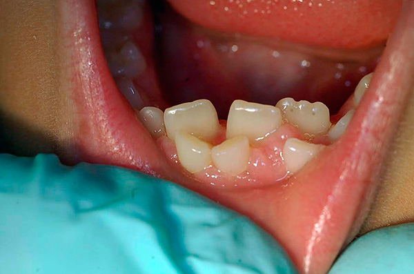 Ако су трајни зуби већ избили, а млечни зуби нису сами испадали, онда је с великом вероватноћом потребно уклањање.