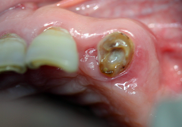 Oft sind stark beschädigte Zähne mit einer Pinzette kaum zu greifen, da nichts zu greifen ist.