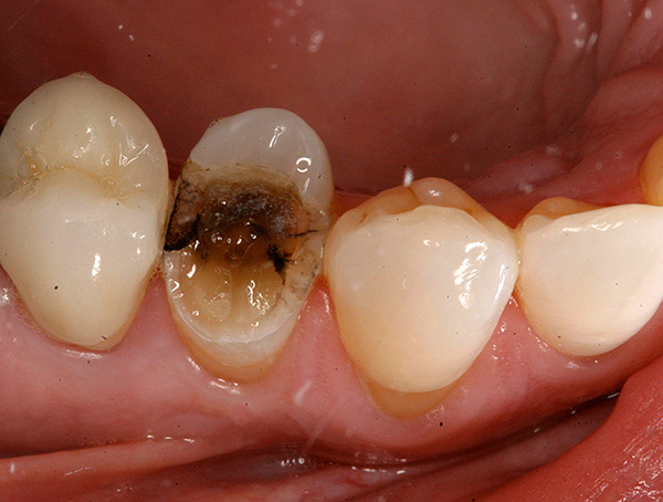 Het komt vaak voor dat wanneer je een tand met een tang probeert te grijpen, de kroon, verpletterd door cariës, afbrokkelt en breekt met een knelpunt.