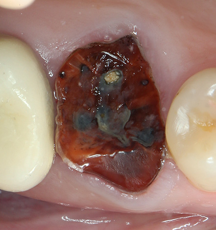 A veces, tales raíces de dientes podridas tienen que cortarse literalmente en pedazos, lo que contribuye al costo final del procedimiento.