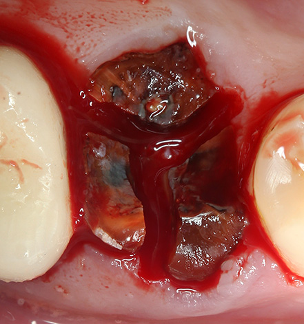 Valokuvassa näkyy, kuinka hampaan juuri, joka on sahattu kolmeen osaan poralla.