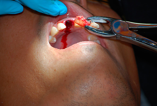 La pràctica demostra que, en casos rars, els cirurgians dentals treuen les dents equivocades i el pacient, de vegades, ha de pagar un doble preu.